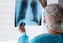 ¿Qué le pasó a Paul, hombre que pensó que tenía problemas de gases cuando en realidad sufría un colapso pulmonar?